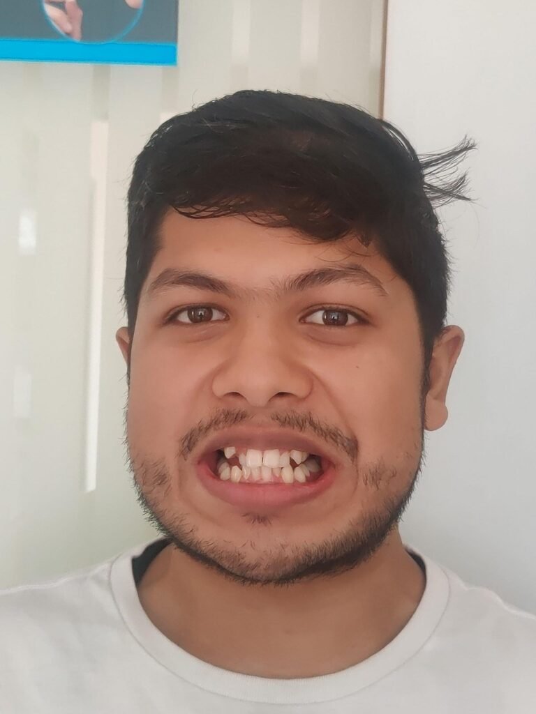 before image of brace alignment patient Four Bangalore