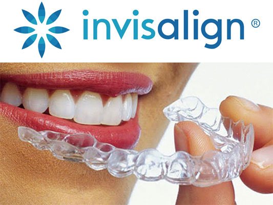Invisalign brace image in bangalore