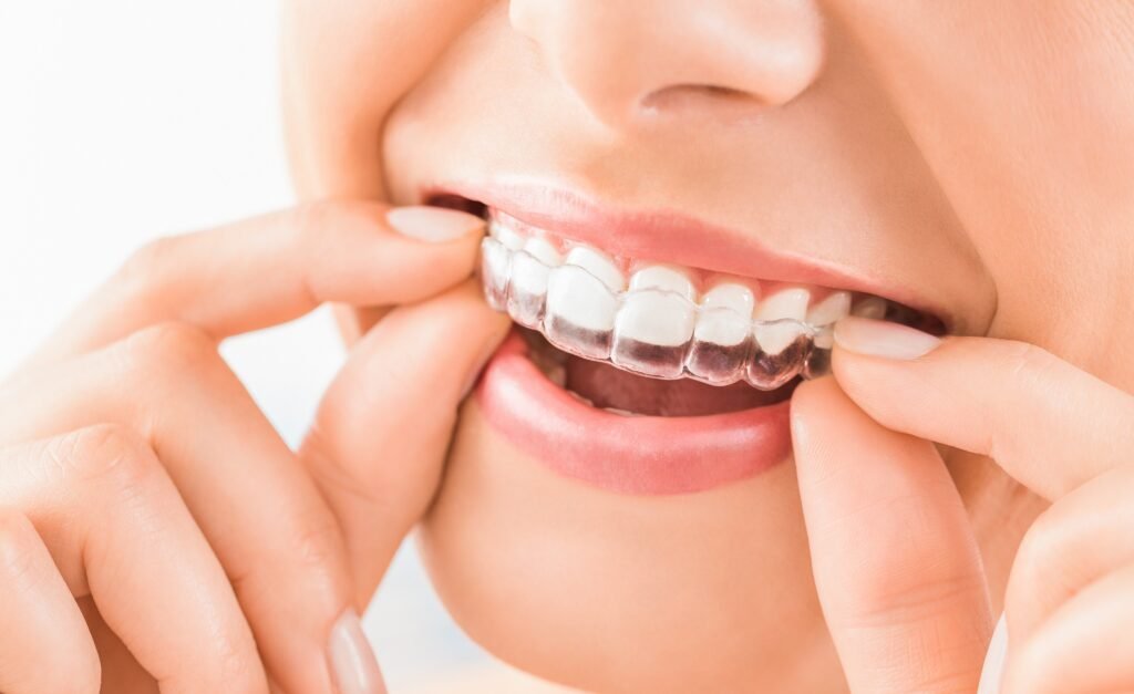 Invisalign clear aligner in Bangalore