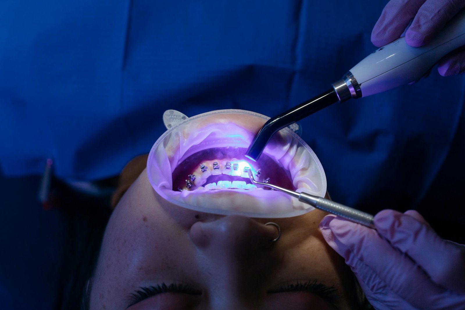 UV light curing dental procedure for teeth whitening and health care. Types of braces are available
