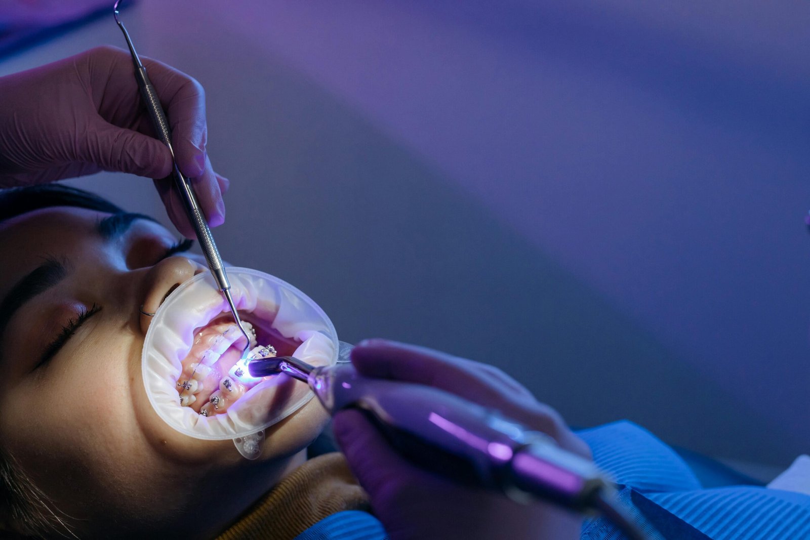 Dental treatment process focusing on orthodontic braces using UV light by a professional. Are braces painful?