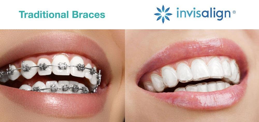 Invisalign vs Traditional Braces