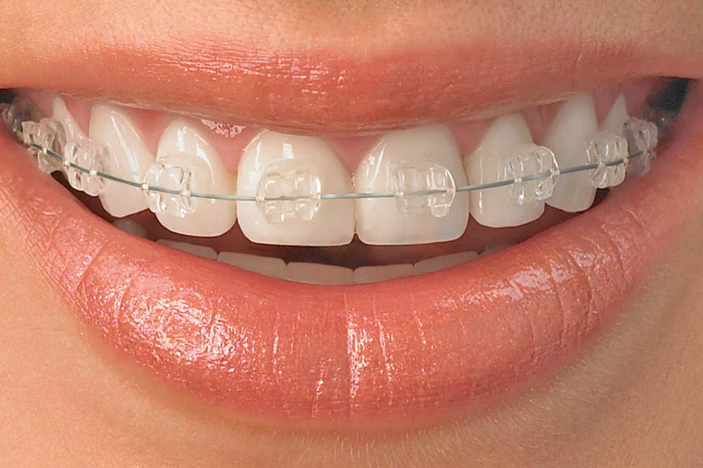 ceramic-braces