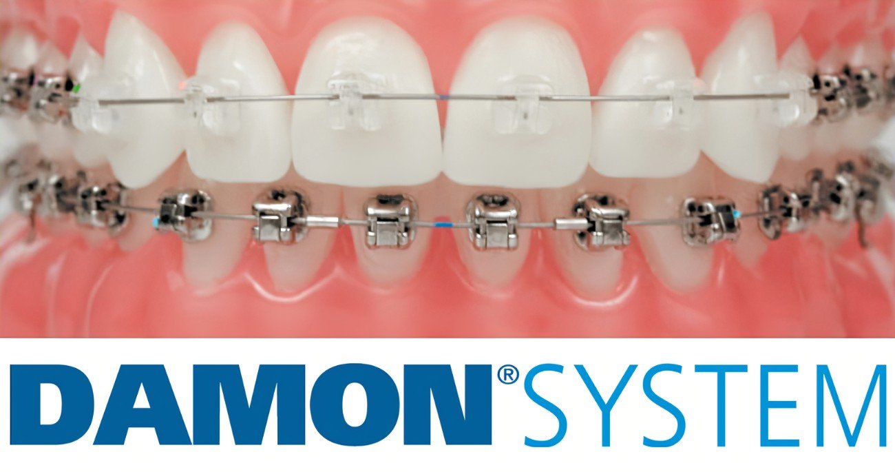 damon brackets