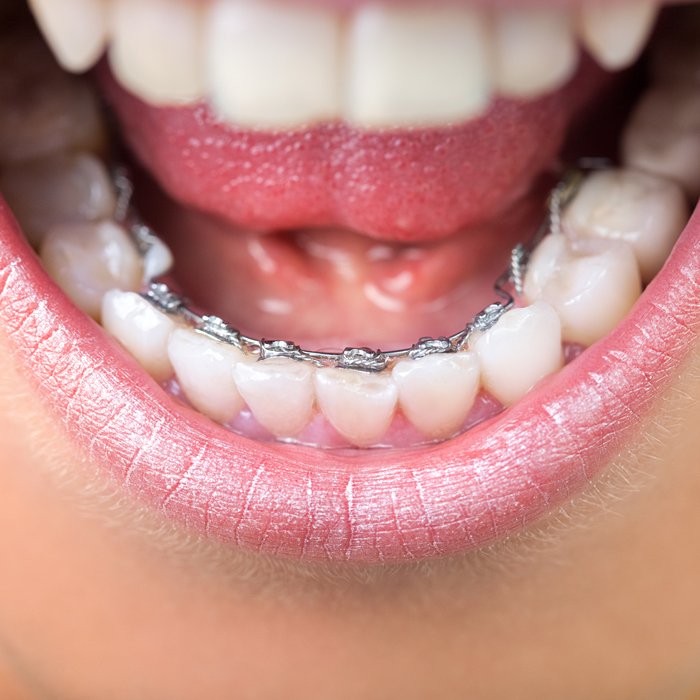 lingual braces