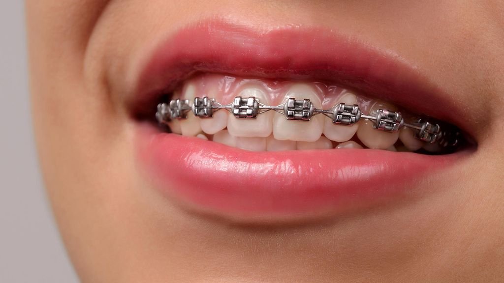 metal braces