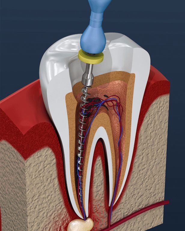 root canal treatment