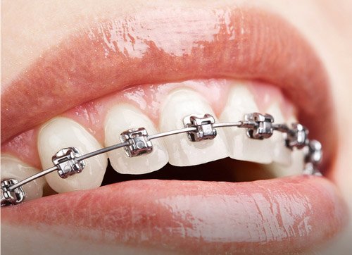 self-ligating brackets