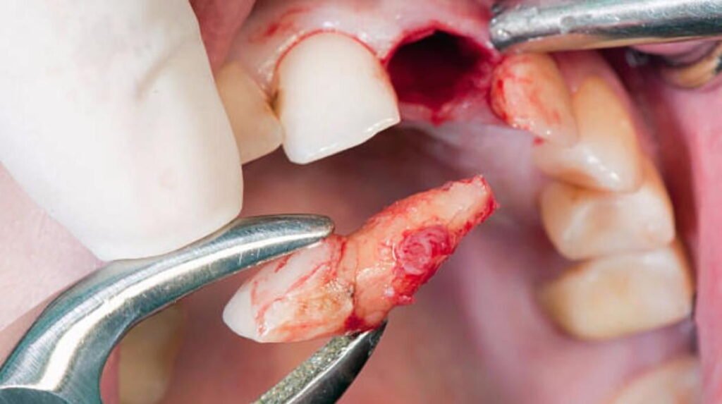 tooth extraction